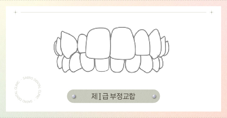 교정 얼굴형 변화 (양악교정 비수술양악) 관련 이미지 3