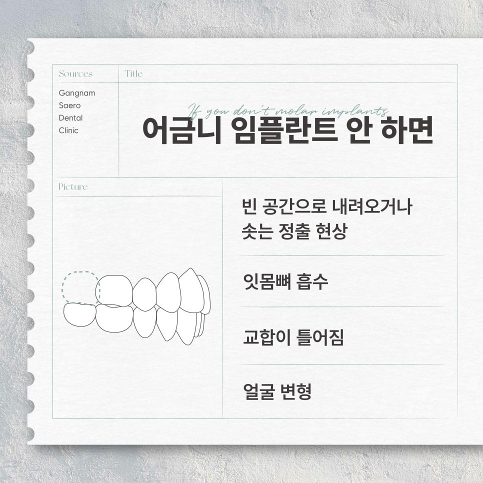(어금니임플란트) 어금니 발치 후 임플란트 해야 하는 이유 관련 이미지 5