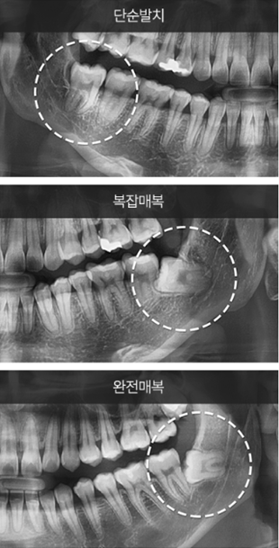 강남역근처치과 사랑니부작용 (사랑니발치) 관련 이미지 7