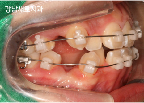 비발치교정 치료, 발치 없이 진행하는 과정 관련 이미지 2