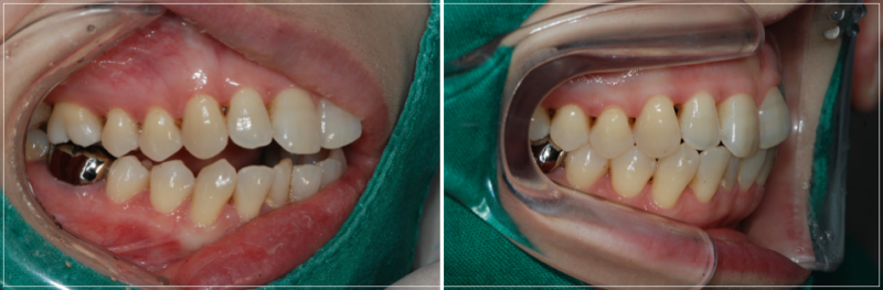 입안다물어짐 비수술로 해결이 가능하다면 관련 이미지 2