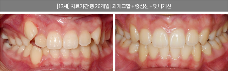 강남투명교정, 강남새로치과 나노라이너의 차별점 관련 이미지 9