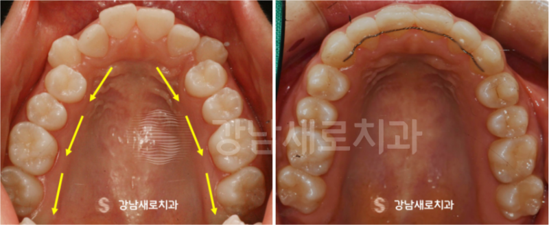 강남역교정치과를 찾고 계신다면? 비발치로 해결하세요! 관련 이미지 6
