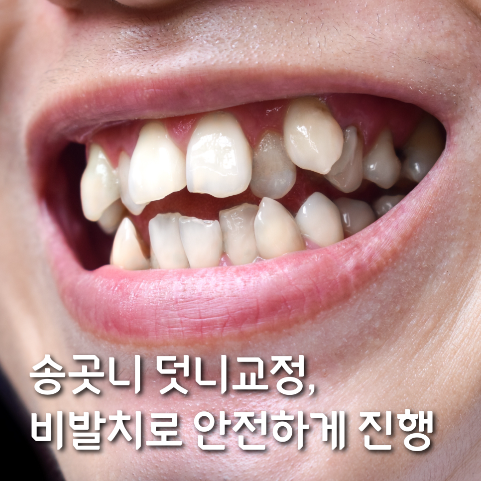 송곳니 덧니교정, 비발치로 안전하게 진행 관련 이미지 1