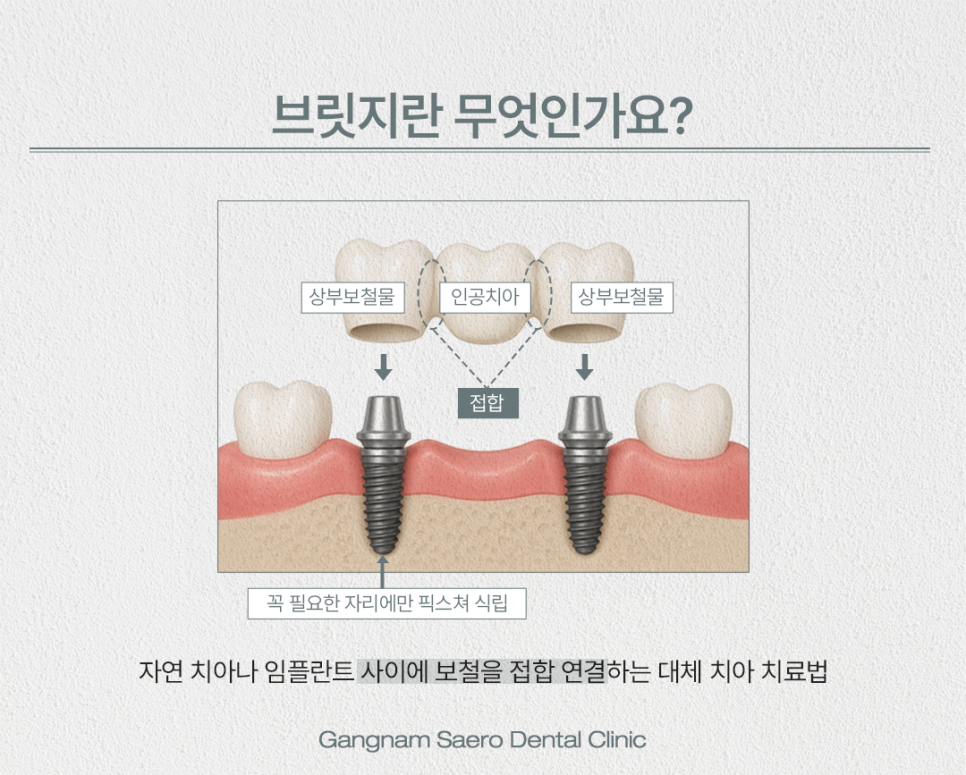 치아를 잃었을 때 치료 방법 (치과 브릿지) 관련 이미지 2