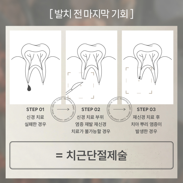 발치 전 최후의 수단 자연치아보존 (치근단절제술) 관련 이미지 5