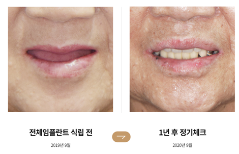 An Efficient Choice When Only a Few Teeth Remain (Full-Mouth Implant Effect) image 3