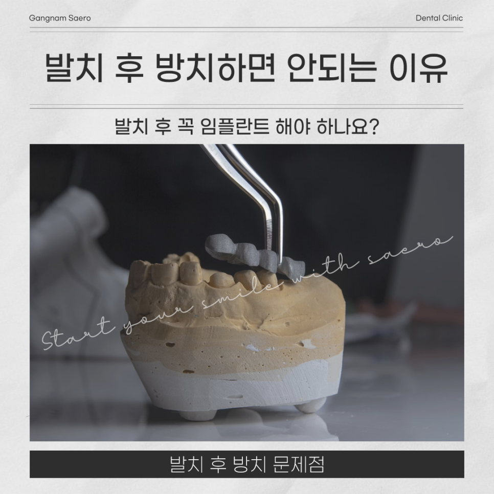 발치 후 꼭 임플란트 해야 하나요? (임플란트안하면) 관련 이미지 1