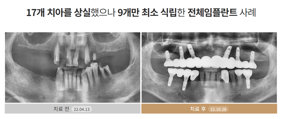 65세이상임플란트 (전체임플란트전후) 관련 이미지 5