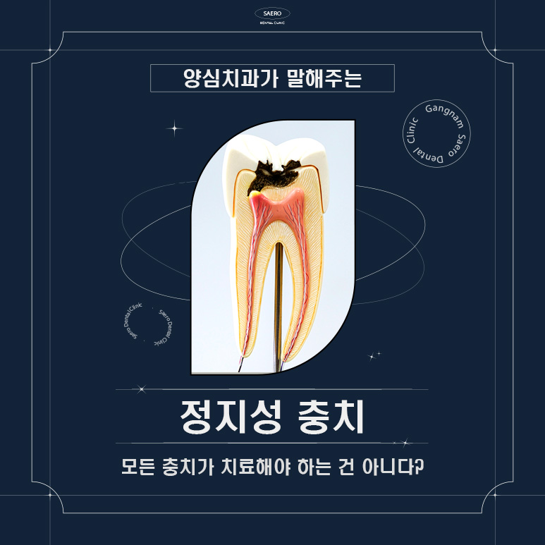 양심치과가 말해주는 모든 충치가 치료해야 하는 건 아니다? (정지성충치) 관련 이미지 1
