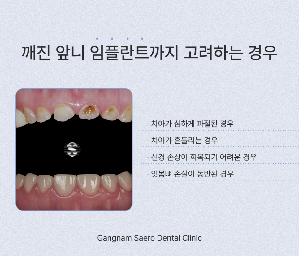 앞니깨졌을때, 깨진앞니 치료하는 여러 가지 방법 레진 / 라미네이트 / 크라운 / 임플란트 관련 이미지 7