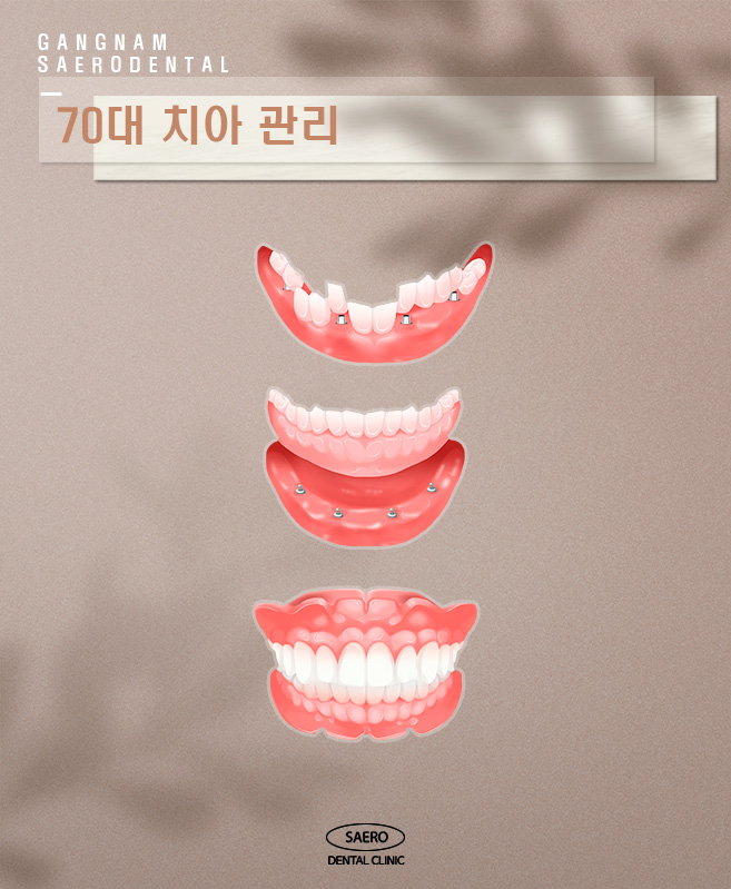 연령별 치아 관리 (임플란트 브릿지 틀니 비교) 관련 이미지 7