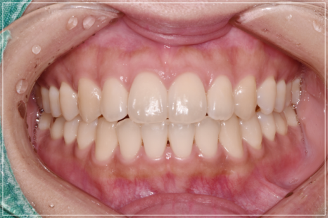 입안다물어짐 비수술로 해결이 가능하다면 관련 이미지 12