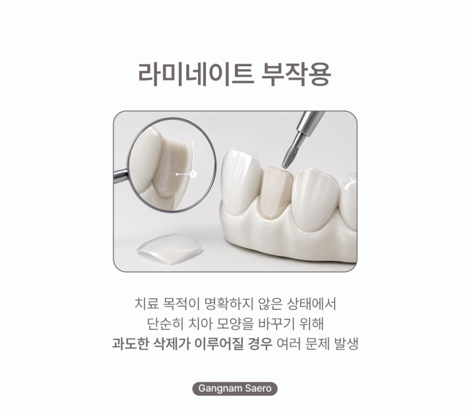 치아 삭제 부담을 줄인 심미 치료 (라미네이트대체 에어네이트) 관련 이미지 2