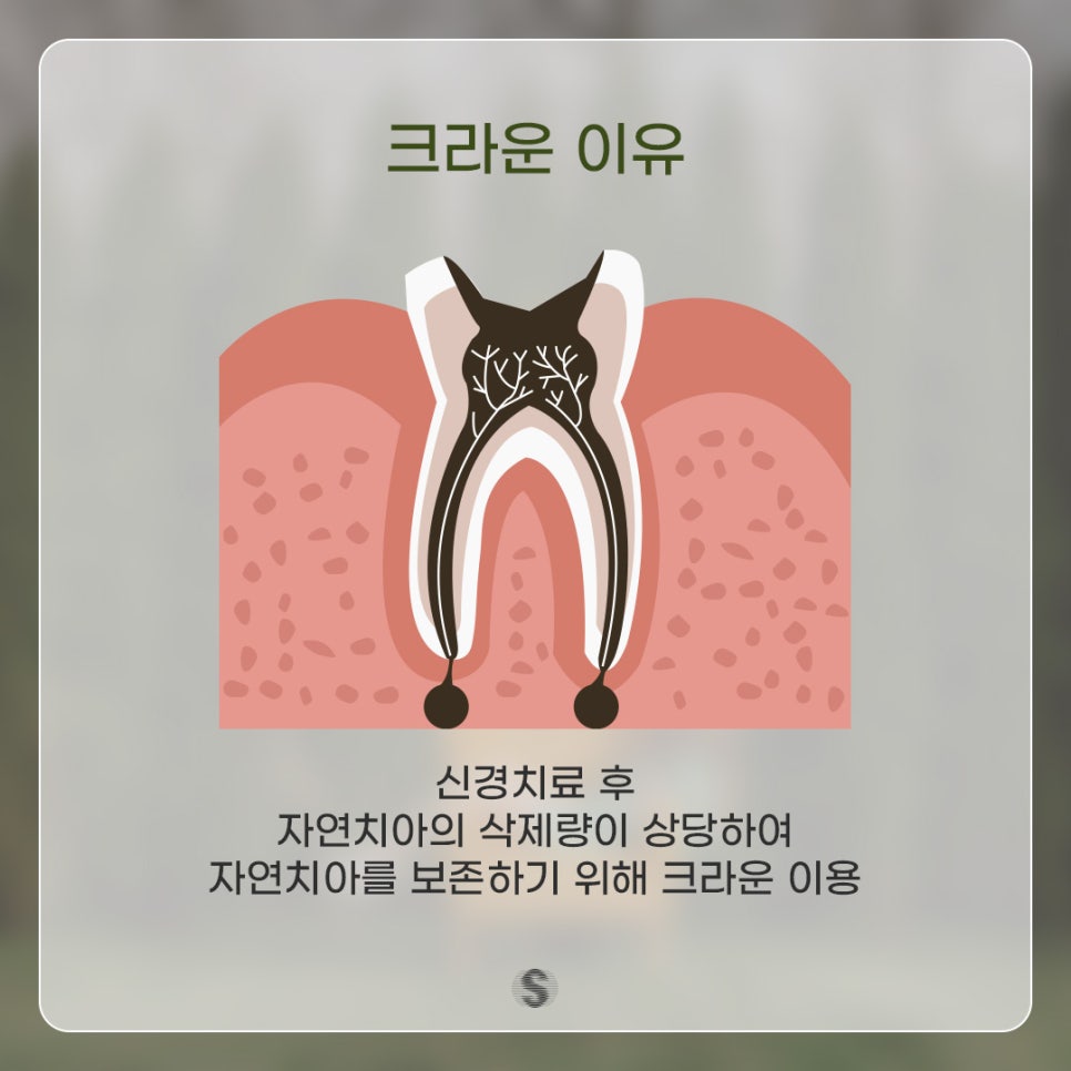 충치치료 신경치료 후 씌우기 (크라운이란?) 관련 이미지 2