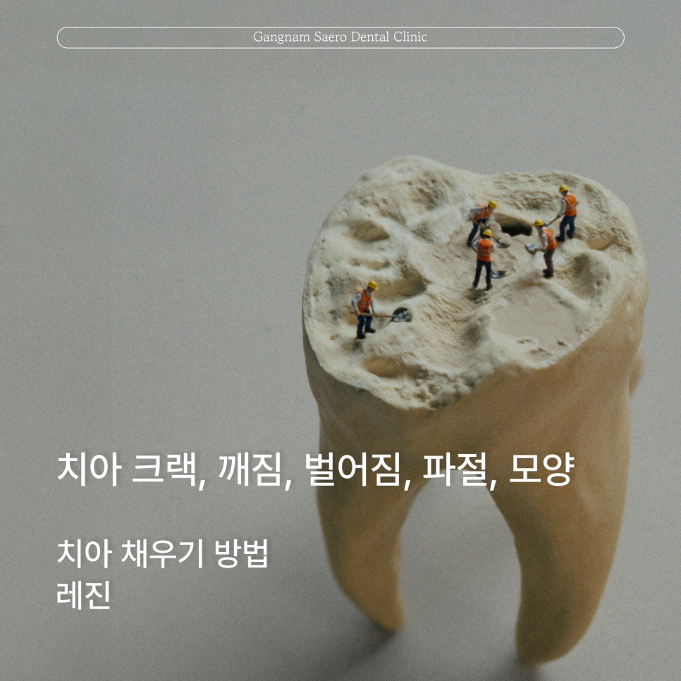 (치아레진 으로 치료하는) 치아크랙 치아깨짐 치아벌어짐 치아파절 치아모양 관련 이미지 1