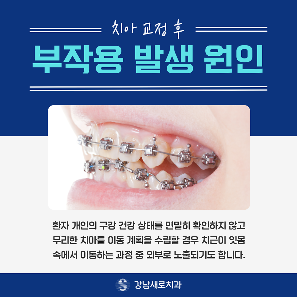 치아 교정 후 부작용이 발생하는 원인? 관련 이미지 3