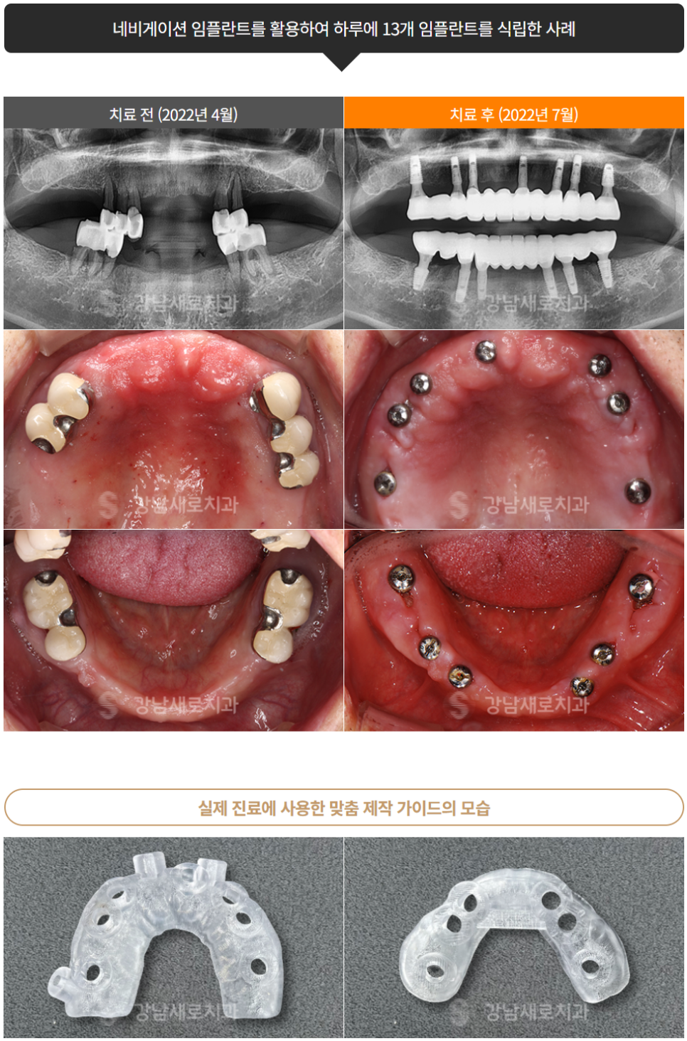 부작용 줄이는 임플란트 [ 네비게이션 임플란트 ] [ 강남새로치과 ] 관련 이미지 9