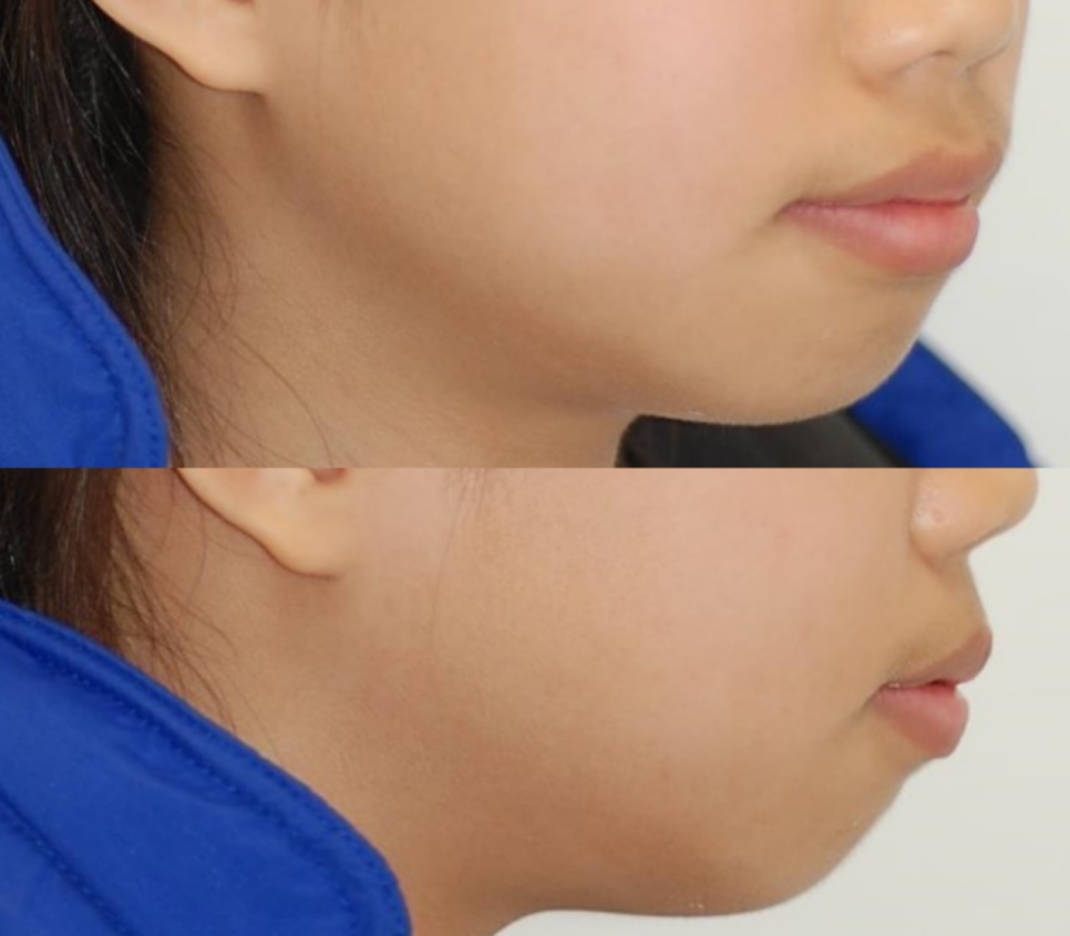 콤플렉스인 뻐드렁니 돌출입 교정으로 개선이 가능할까? 관련 이미지 4