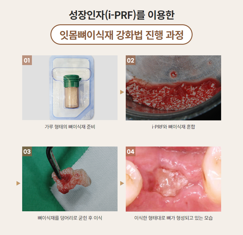 당뇨, 고혈압, 골다공증 대상 임플란트 안내 [ PRF 임플란트 ] [ 강남새로치과 ] 관련 이미지 4