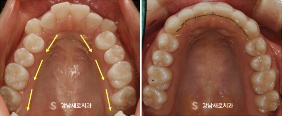 비발치교정치료, 부작용 피하는 방법? 관련 이미지 6