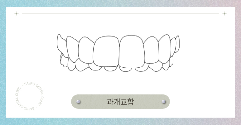 부정교합 투명교정으로 교정이 되나요? (부정교합교정) 관련 이미지 8