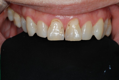 법랑질 삭제를 최소로 하는 헨리라미네이트 관련 이미지 7