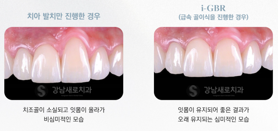 Dental Implant Side Effects: Gums (Periodontal and Gum Tissue Damage) — Prevention and Management image 5