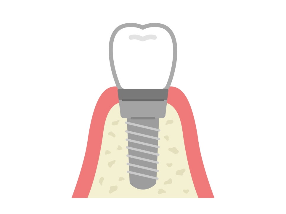 임플란트 치료, 보철물 수명, 교체 시기, 구강을 위해 알아둡시다. 관련 이미지 5