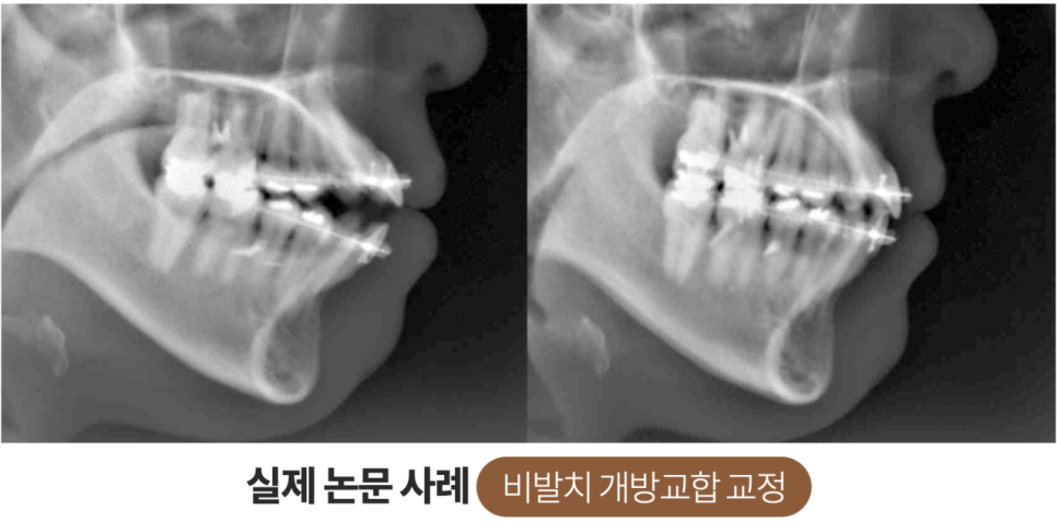 콤플렉스인 뻐드렁니 돌출입 교정으로 개선이 가능할까? 관련 이미지 11
