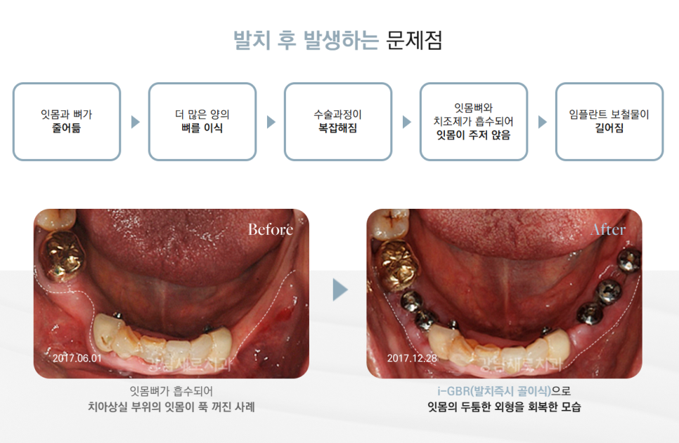 임플란트수술 단순히 심는 줄로만 알았다면 확인해 봐야 할 (임플란트수술) 관련 이미지 6
