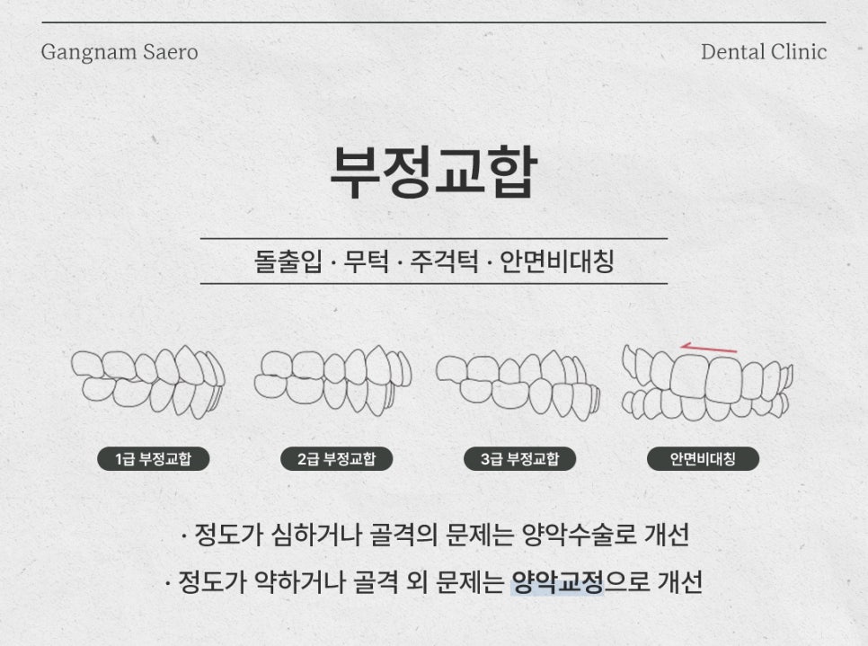 치아교정 으로 해결하는 외모 콤플렉스 (부정교합교정 앞니교정 잇몸교정) 관련 이미지 2