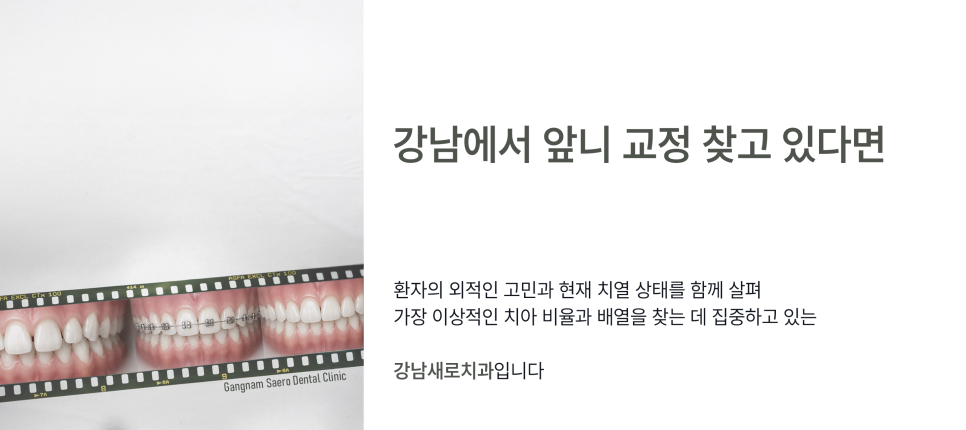 앞니만 교정하고 싶다면 부분만 교정하는 (앞니교정) 관련 이미지 9