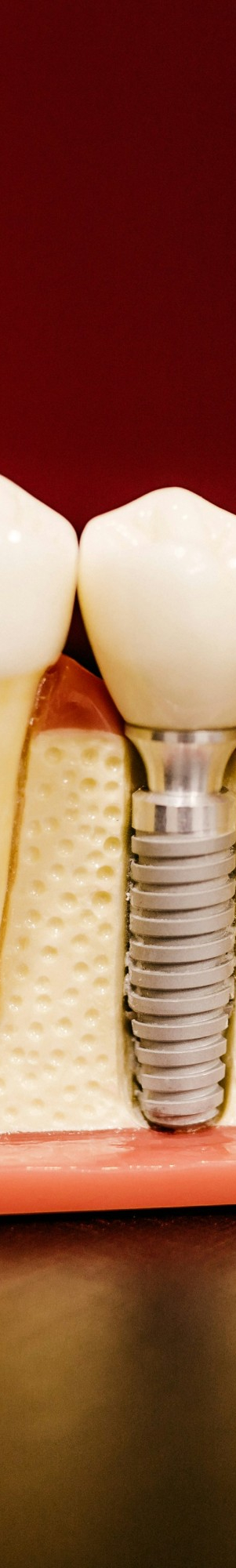 임플란트 식립이 불가능할 수도 있는 건강 상태 알아보기. 관련 이미지 9