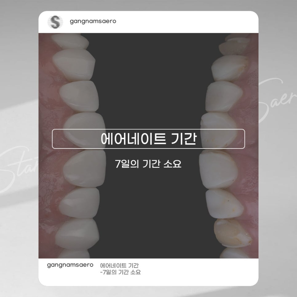 무삭제라미네이트 로 완성하는 가장 빠른 치아성형 (7DAYS치아성형) 관련 이미지 5
