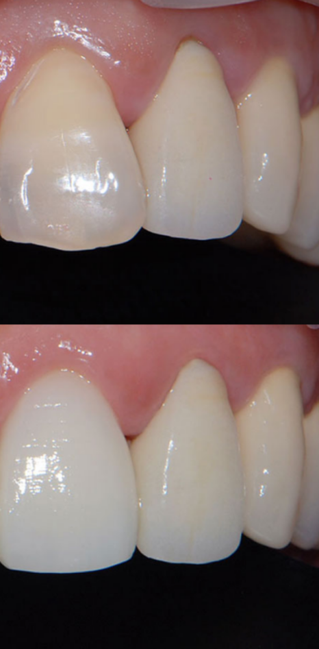 풍자 라미네이트? 치아 삭제 없는 과정으로 관련 이미지 4