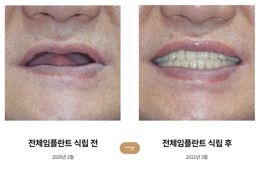 65세이상임플란트 (전체임플란트전후) 관련 이미지 1