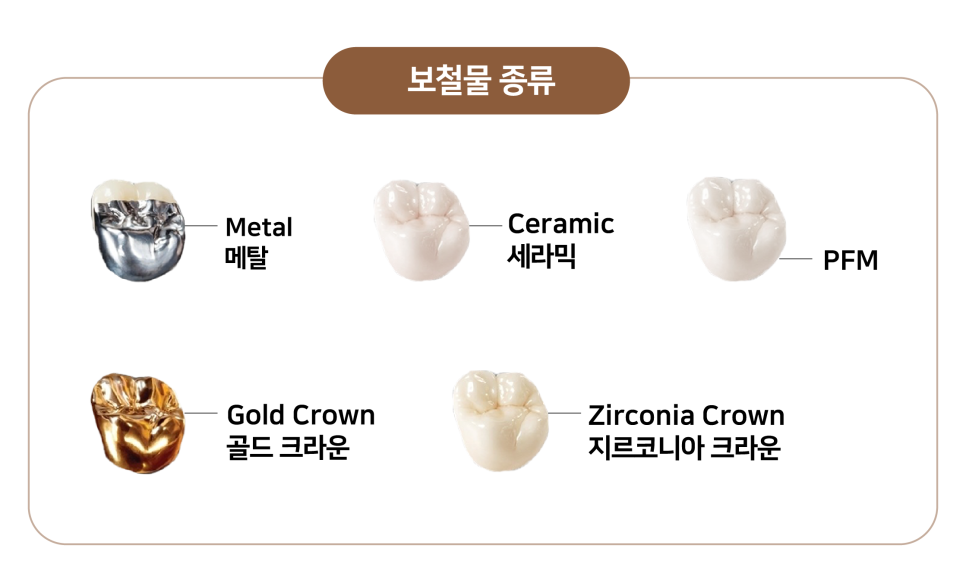 임플란트부작용 보철 (크라운, 지대주, 픽스쳐) 예방 및 대처 방법 관련 이미지 4