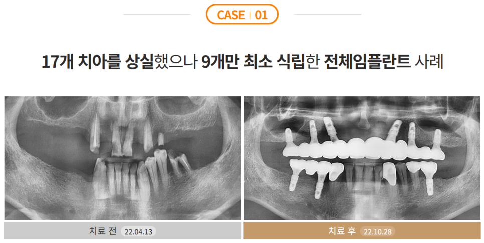 전체임플란트 부작용 최소화하려면 (성공률 높은 임플란트) 관련 이미지 3