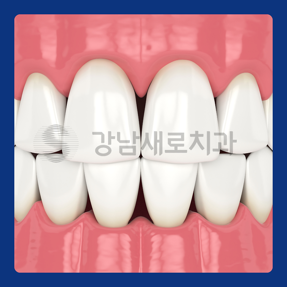 치아 교정 후 부작용이 발생하는 원인? 관련 이미지 7