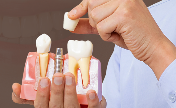 임플란트 잘하는 병원 (전체임플란트) 관련 이미지 2