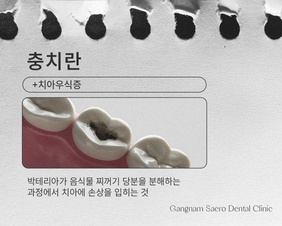 Types and Materials of Dental Caries Treatment by Stage (Types of Cavity Treatment) image 2