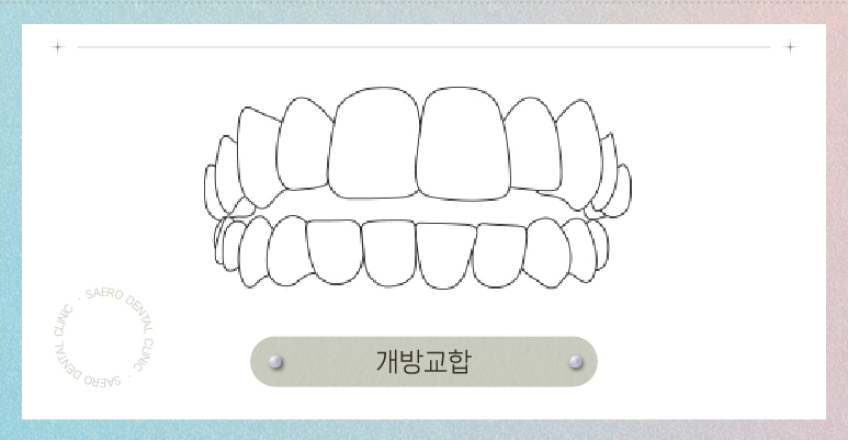 부정교합 투명교정으로 교정이 되나요? (부정교합교정) 관련 이미지 7