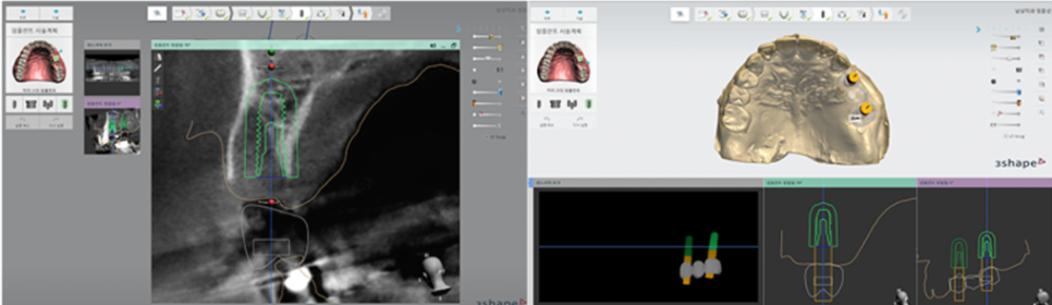 임플란트부작용 걱정된다면 강남새로치과 네비게이션 임플란트 (임플란트통증) 관련 이미지 5