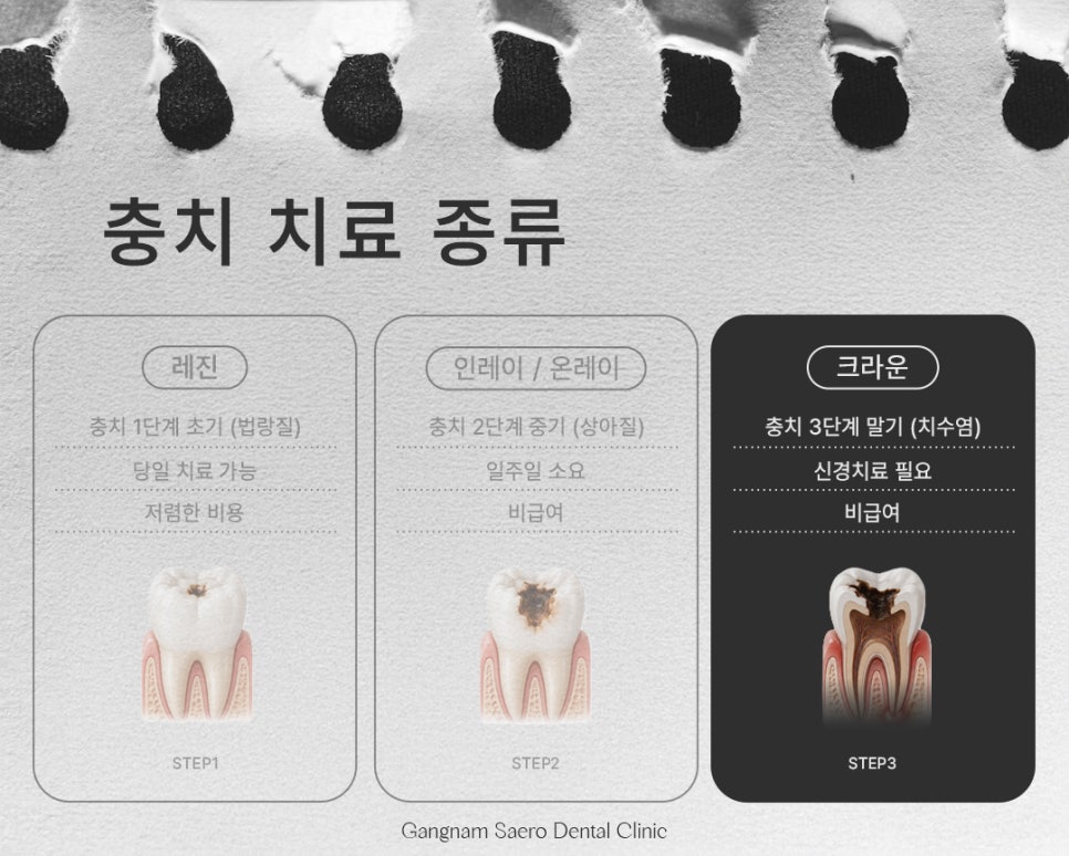 Types and Materials of Dental Caries Treatment by Stage (Types of Cavity Treatment) image 7