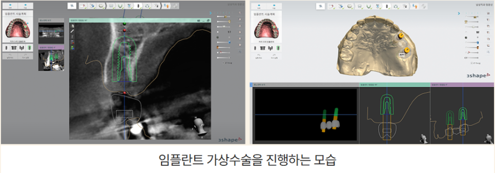 전체임플란트 부작용 최소화하려면 (성공률 높은 임플란트) 관련 이미지 7