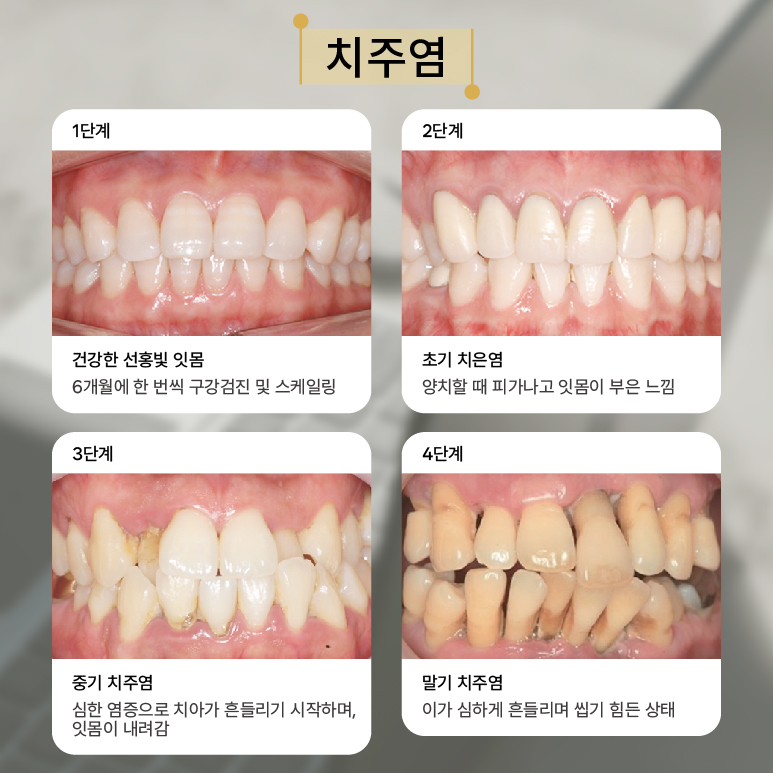 입냄새부터 치주질환까지 예방을 위한 스케일링 보험적용 안내 (근처치과스케일링) 관련 이미지 3
