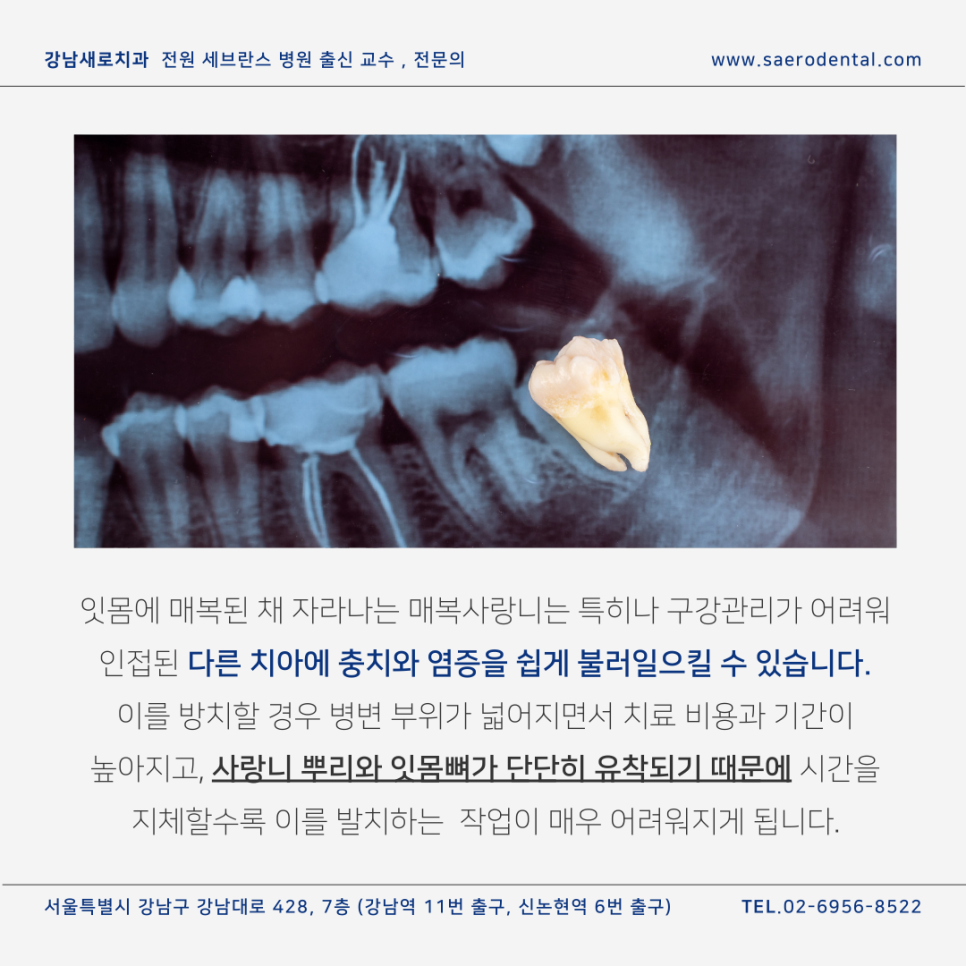 강남사랑니치과, 매복사랑니를 더욱 효율적으로 발치하려면 관련 이미지 4