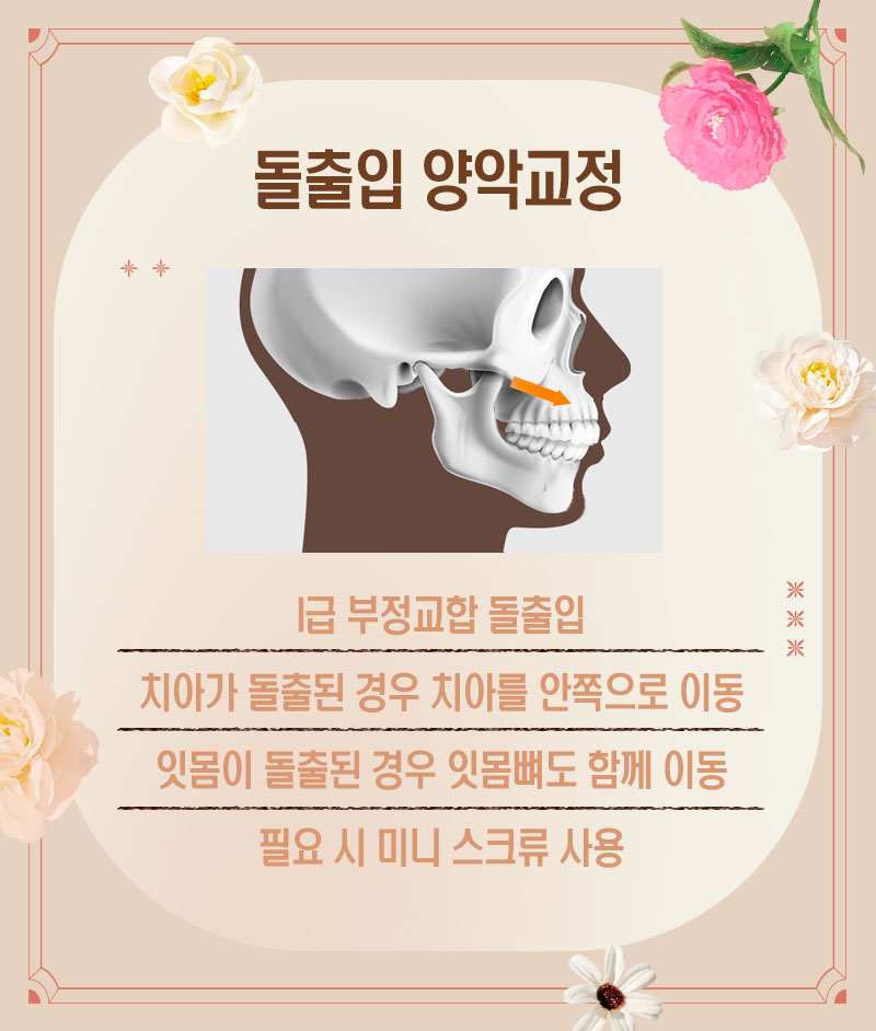 교정으로 얼굴형 변화시킬 수 있다?! (유형별 양악교정 안내) 관련 이미지 3