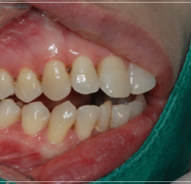 입 안 다물어짐 수술 없이 해결하는 방법 관련 이미지 3